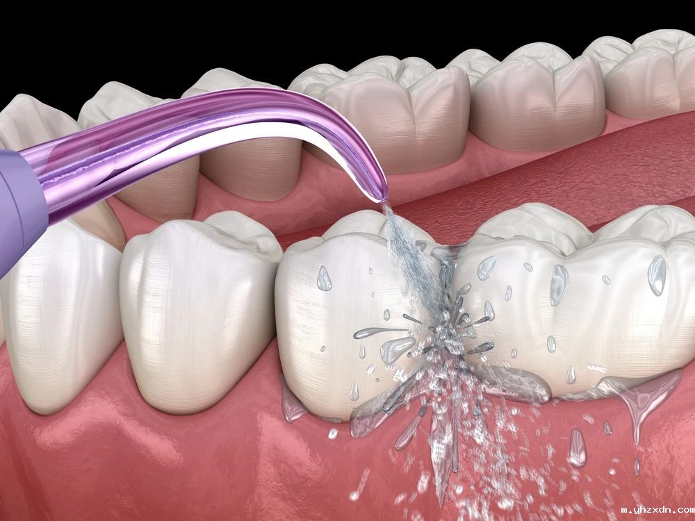 牙菌斑清洁_上海高端医院