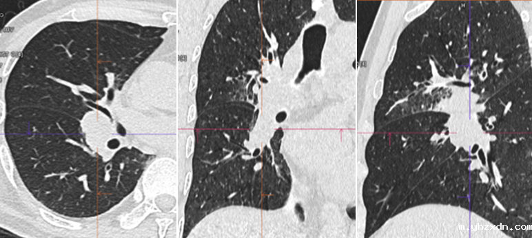 yhzxdn_胸部CT结果.png