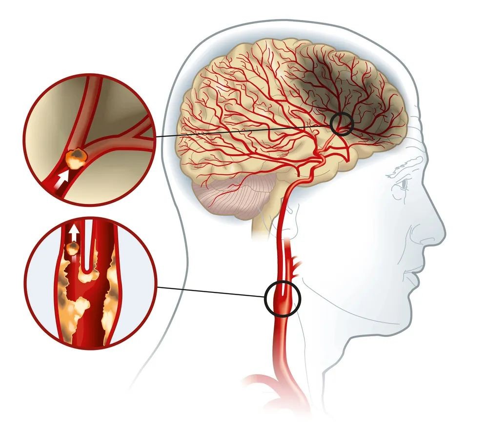 上海yhzxdn医院_颈动脉斑块的治疗