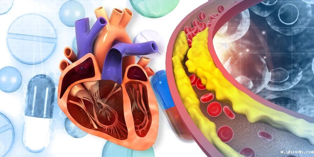 上海高端医院_颈动脉斑块的治疗