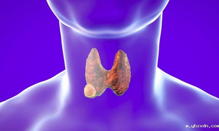 thyroid-nodule-cancer