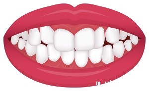 Overcrowded Overcrowded