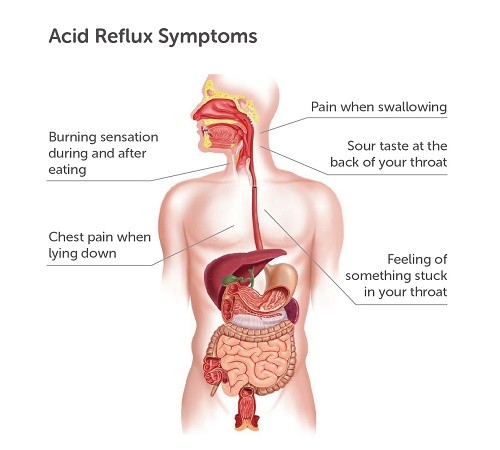 Acid Reflux Symptoms Acid Reflux Symptoms